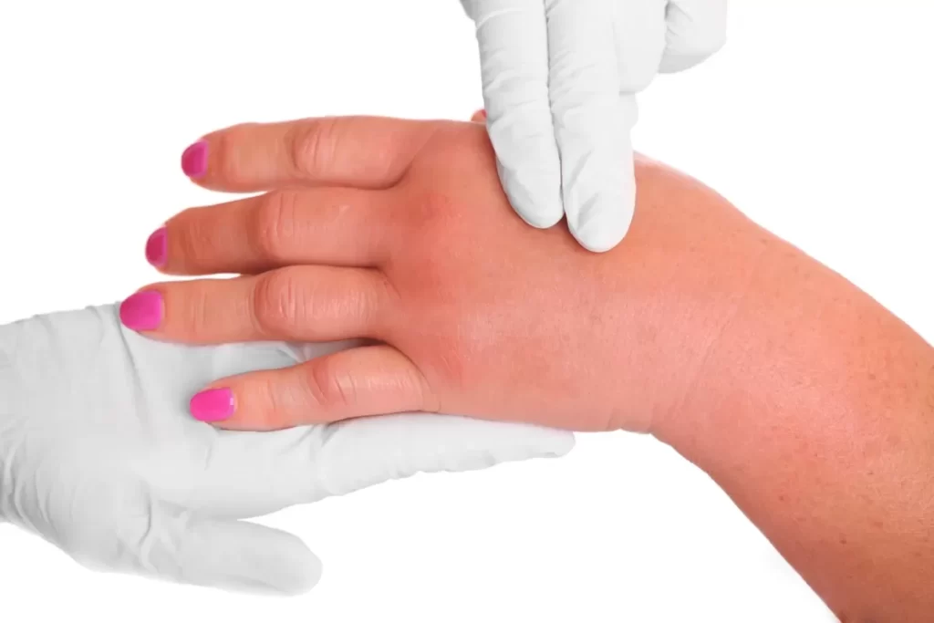 De ce se umfla mainile si cum sa ameliorezi rapid simptomele acasa